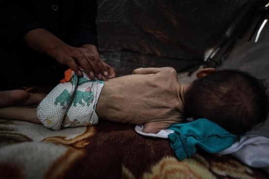 這是5月28日在加沙城西部一處臨時(shí)安置點(diǎn)拍攝的一名營(yíng)養(yǎng)不良的嬰兒。新華社發(fā)（馬哈茂德·扎基攝）
